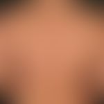 Granuloma anulare perforans, general view: Skin-coloured to reddish, rough, smooth, peripherally ...
