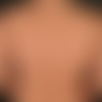 Granuloma anulare perforans, general view: Skin-coloured to reddish, rough, smooth, peripherally ...