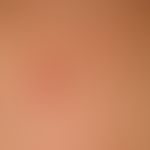 Granuloma anulare perforans. detail enlargement: solitary or densely standing, skin-coloured to r...