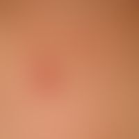 Granuloma anulare perforans. detail enlargement: solitary or densely standing, skin-coloured to r...