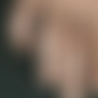 Granuloma anulare subcutaneum. Multiple, chronically stationary, firm, symptomless, subcutaneousl...