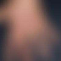 Granuloma anulare subcutaneum. 3 years of continuously multiplying, multiple, mostly aggregated, ...