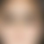 Granuloma eosinophilicum faciei (Granuloma faciale). 6-month-old finding in a 7-year-old child. S...