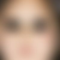 Granuloma faciale:&nbsp;seit 6 Monaten bestehender Befund bei einem 7-jährigen Kind. Leicht erhab...