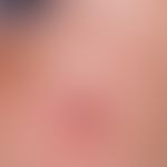 Granuloma eosinophilicum faciei. red lump in the area of the cheek in a child, existing for month...
