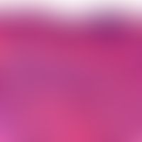 Granuloma eosinophilicum faciei (Granuloma faciale). dense, diffuse infiltrate in the upper and m...