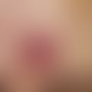 Granuloma faciale:&nbsp;Ca. 0,8 cm durchmessender, solitärer, langsam wachsender, leicht erhabene...