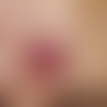 Granuloma eosinophilicum faciei (Granuloma faciale). approx. 0.8 cm in diameter, solitary, slow-g...