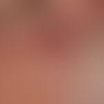 Granuloma eosinophilicum faciei (Granuloma faciale): Typical finding in a 72-year-old man. No sig...