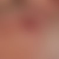 Granuloma eosinophilicum faciei (Granuloma faciale): Typical finding in a 72-year-old man. No sig...