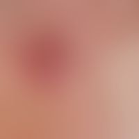 Granuloma eosinophilicum faciei (Granuloma faciale): Detailaufnahme.
