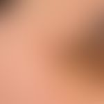 Granuloma eosinophilicum faciei: Very discreet, symptom-free, flat plaque that has existed at thi...