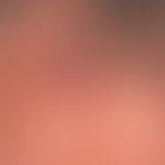 Granuloma eosinophilicum faciei (Granuloma faciale): Therapy resistant 2.5 cm high, red, surface ...
