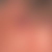 Granuloma eosinophilicum faciei (Granuloma faciale): Therapy resistant 2.5 cm high, red, surface ...
