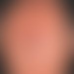 Granuloma eosinophilicum faciei (Granuloma faciale): Unusual, flat, completely asymptomatic, exis...