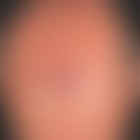 Granuloma eosinophilicum faciei (Granuloma faciale): Unusual, flat, completely asymptomatic, exis...