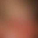 Granuloma fissuratum. Bei dem 70-jährigen Patienten besteht seit einigen Monaten eine gerötete, d...