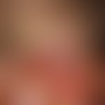 Granuloma fissuratum. Bei dem 70-jährigen Patienten besteht seit einigen Monaten eine gerötete, d...