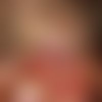 Granuloma fissuratum. Bei dem 70-jährigen Patienten besteht seit einigen Monaten eine gerötete, d...