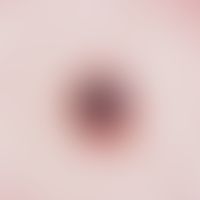 Granuloma pyogenicum (pyogenic granuloma) Rapidly growing, bluish-black, soft, slightly bleeding ...