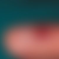 Granuloma py ogenicum (pyogenic granuloma) A 14-day-old, trauma-induced, centrally ulcerated, sli...