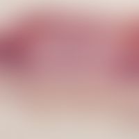 Granuloma pyogenicum (pyogenic granuloma) Tumour surrounded by an epithelial lip formation, centr...