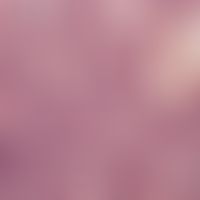 Granuloma pyogenicum (pyogenic granuloma) bundle with partly solid, partly differently sized lumi...