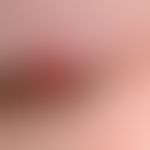 Granuloma pyogenicum (pyogenic granuloma) Detail view of a solitary, since 6 weeks size progressi...