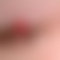Granuloma pyogenicum (pyogenic granuloma) Detail view of a solitary, since 6 weeks size progressi...