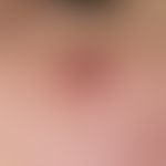 Granuloma pyogenicum (pyogenic granuloma). 0,6 cm tall, soft, spherical, slightly bleeding, red-b...