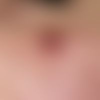 Granuloma pyogenicum (pyogenic granuloma). 0,6 cm tall, soft, spherical, slightly bleeding, red-b...