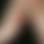 Granuloma pyogenicum (pyogenic granuloma) Following a hammer blow, the 42-year-old carpenter has ...