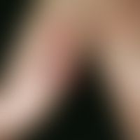 Granuloma pyogenicum (pyogenic granuloma) Following a hammer blow, the 42-year-old carpenter has ...