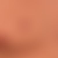 Granuloma pyogenicum (pyogenic granuloma): a painless nodule that has been present for a few week...