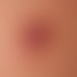 Granuloma pyogenicum (pyogenic granuloma): Close-up: Smooth, shiny surface, eroded in places.
