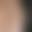 Gynäkomastie: beidseits Vergrößerung der Brustdrüse beim männlichen HIV-Patient unter Einnahme vo...
