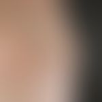 Gynecomastia: enlargement of the mammary gland on both sides in male HIV patients while taking pr...