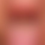Oral hairy leukoplakia. flat white yellowish coating on the tongue; flat leukoplakia on the later...