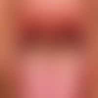 Oral hairy leukoplakia. flat white yellowish coating on the tongue; flat leukoplakia on the later...
