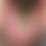 Hairy tongue, black. filamentous, brown-black, hyperkeratotic, hypertrophic Papillae filiformes i...