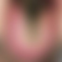 Haarzunge, schwarze. Fadenförmige, braun-schwarze, hyperkeratotische, hypertrophische Papillae fi...