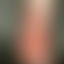 Haemangioma of the infant. asymptomatic, soft, deep red, rough, rough, flat plaque on the right f...