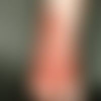 Haemangioma of the infant. asymptomatic, soft, deep red, rough, rough, flat plaque on the right f...
