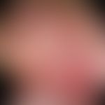 Hämangiom des Säuglings. Übersichtsaufnahme des Kopfes von rechts-lateral: Am Hinterkopf, bis prä...