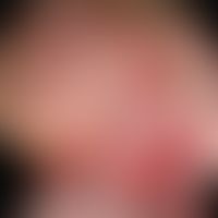 Haemangioma of the infant; general view of the head from the right-lateral side: At the back of t...