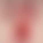 Hämangiom des Säuglings. Skrotal und perineal ausgeprägtes Hämangiom sowie aggregierte Papeln bei...