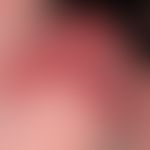 Hämangiom des Säuglings. Chronisch dynamische weiche Anschwellung, innerhalb der letzten 3 Wochen...