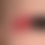 Hämangiom des Säuglings. Chronisch dynamische, innerhalb der letzten 6 Wochen massiv wachsende, d...