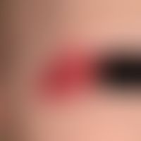 Hämangiom des Säuglings. Chronisch dynamische, innerhalb der letzten 6 Wochen massiv wachsende, d...
