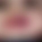 Hämangiom des Säuglings. Seit 5 Monaten bestehender, dynamisch wachsender, 3 x 4 cm großer, livid...